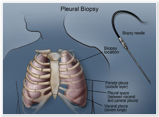 pleural-biopsy