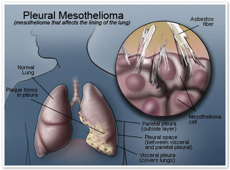 pleural-mesothelioma